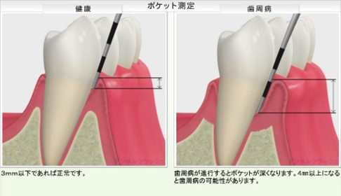歯周病の進行に伴う歯周ポケットの形成