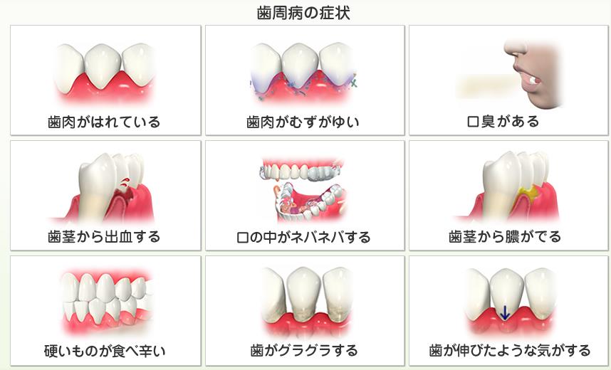 歯科疾患実態調査菌