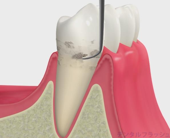 歯周基本治療