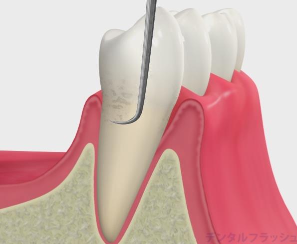 歯周基本治療