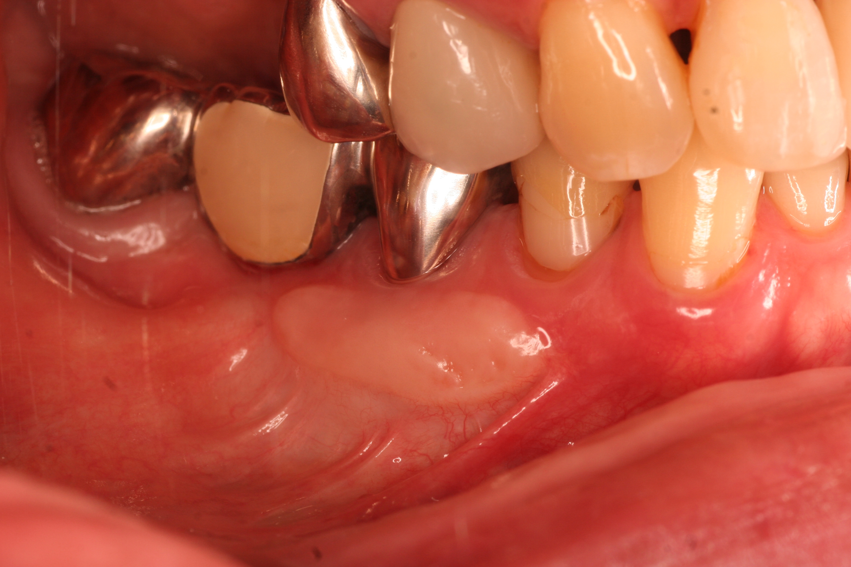 歯肉移植手術（自費治療、一部保険適応）