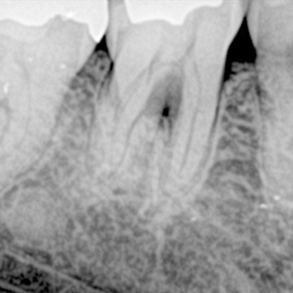 <p>根分岐部病変分岐部の骨吸収 同部位の歯周ポケットは6㎜で排膿も認めます。</p>
