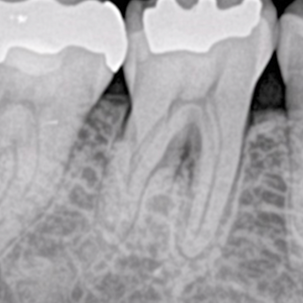 <p>根分岐部骨再生が始まっています。本例では完全に歯槽骨で欠損部を満たすことは困難ですが、歯周病の再発を抑制できるレベルまで骨再生が起きています。ポケット深さは3㎜まで改善しました。</p>
