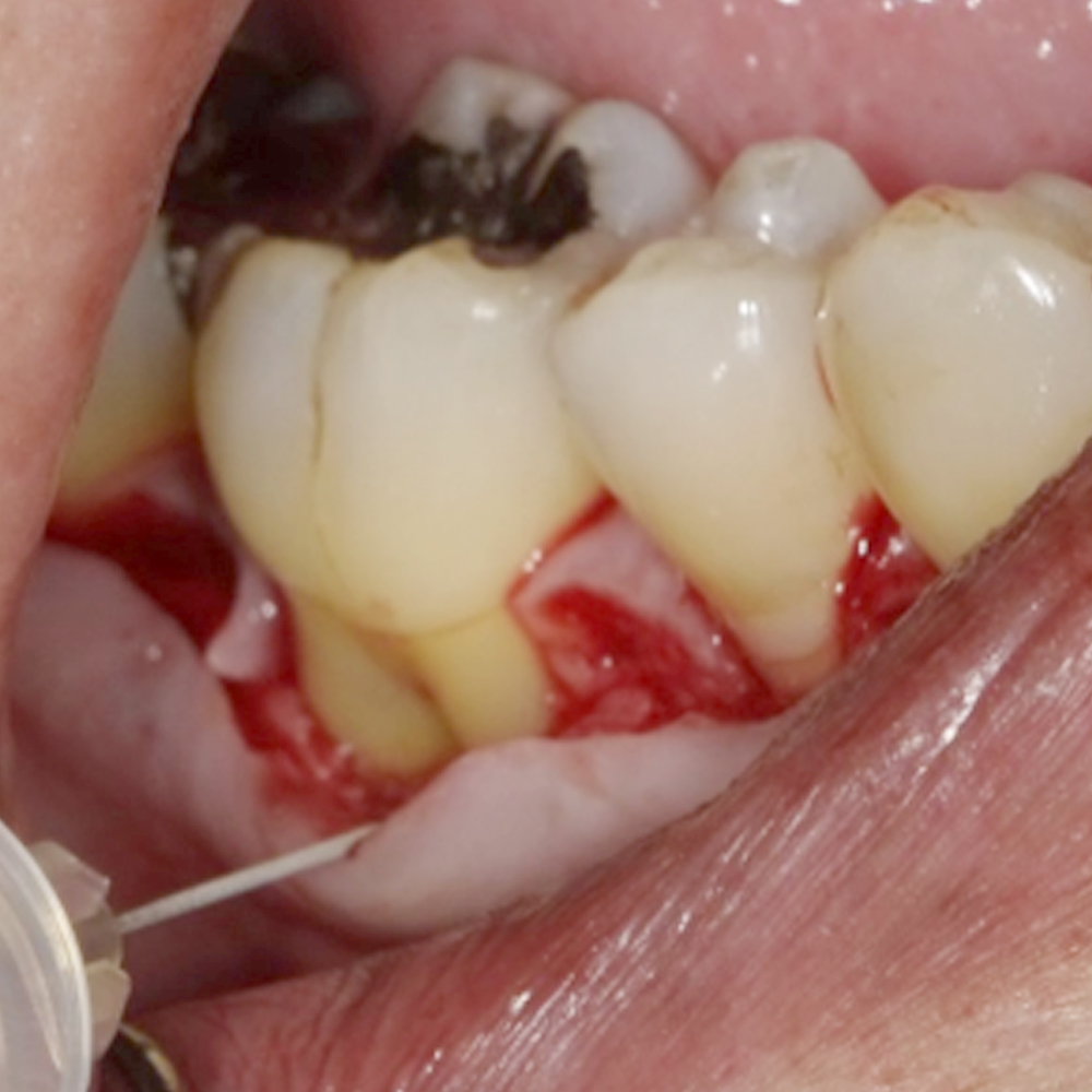 <p>根分岐部に歯周組織再生剤リグロス®を注入します。</p>
